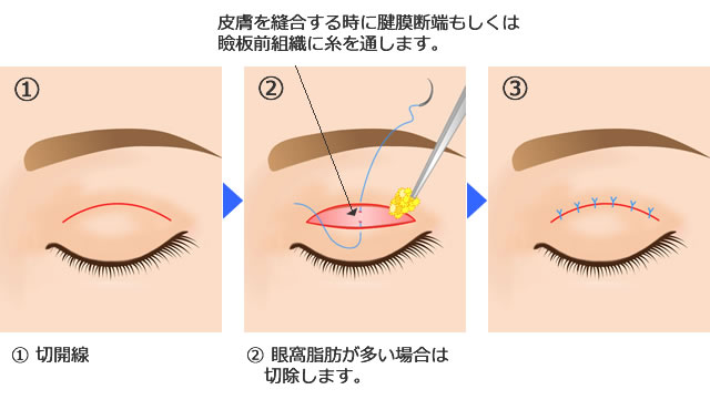 二重